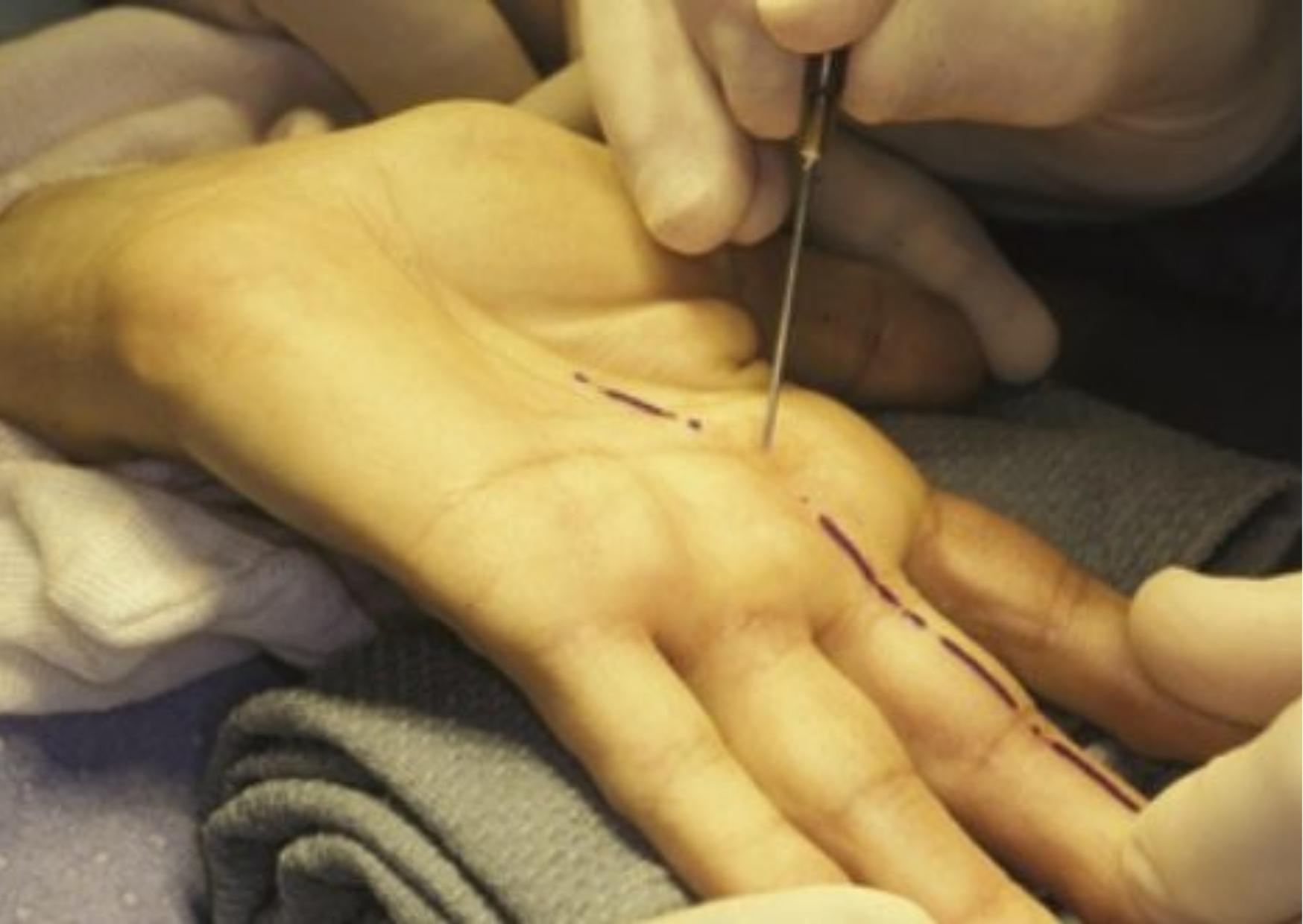 Cirurgia de mão para tratamento do dedo em gatilho