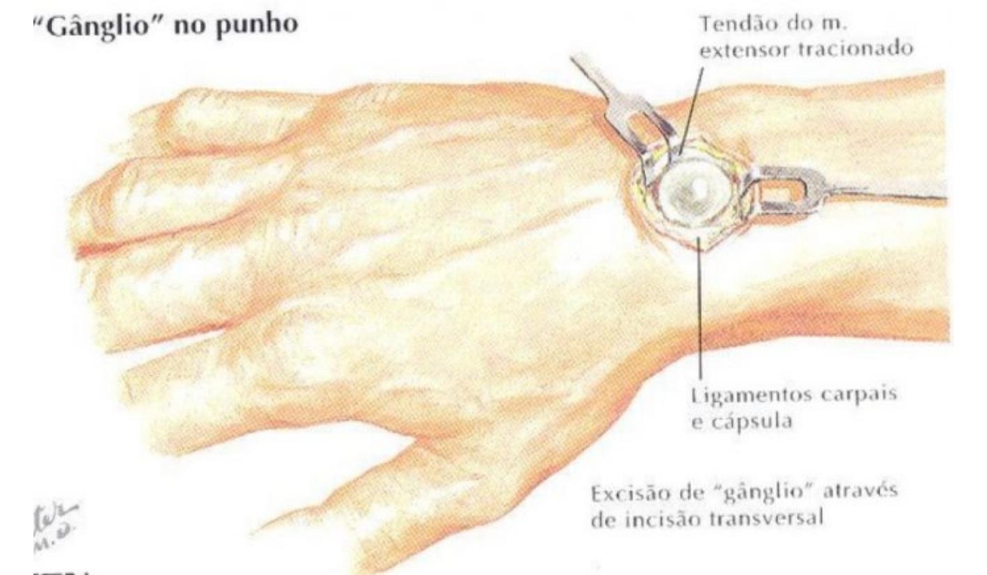 cirurgia cisto sinovial