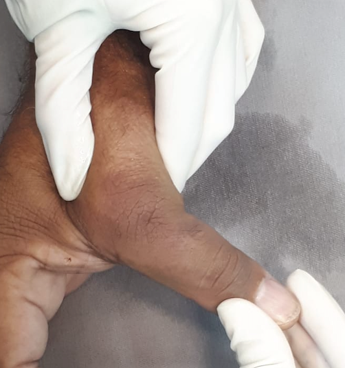 Figura: Instabilidade clínica pela ruptura do ligamento colateral do polegar. Fonte: acervo pessoal.