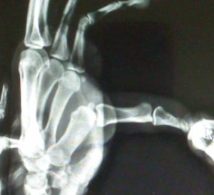 Figura: Raio- x com estresse dinânimo evidenciando a abertura e instabilidade do polegar. Fonte: acervo pessoal.