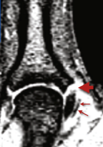 Figura: RNM demostrando lesão do ligamento colateral ulnar do polegar. Fonte: acervo pessoal