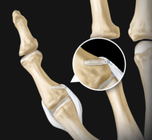 Figura: Reinserção do ligamento colateral ulnar do polegar com uso de mini ancoras. Fonte: SutureTak® Thumb Collateral Ligament Repair- Arthrex