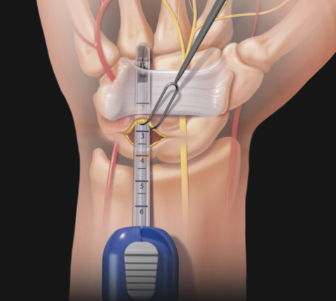 cirurgia mão