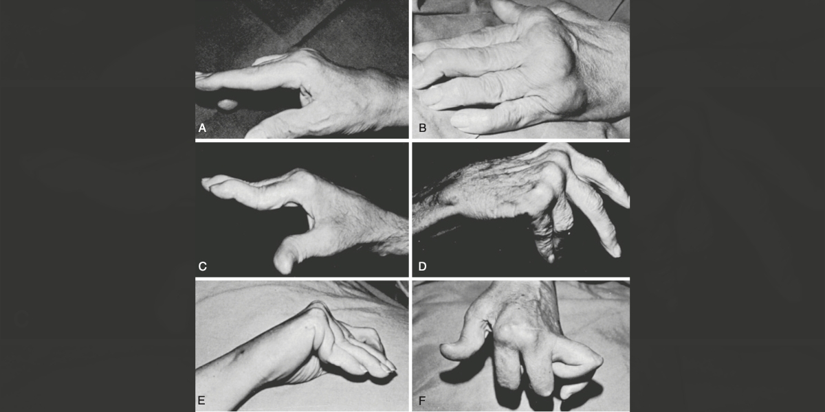 Fotos de mãos com artrite reumatoide