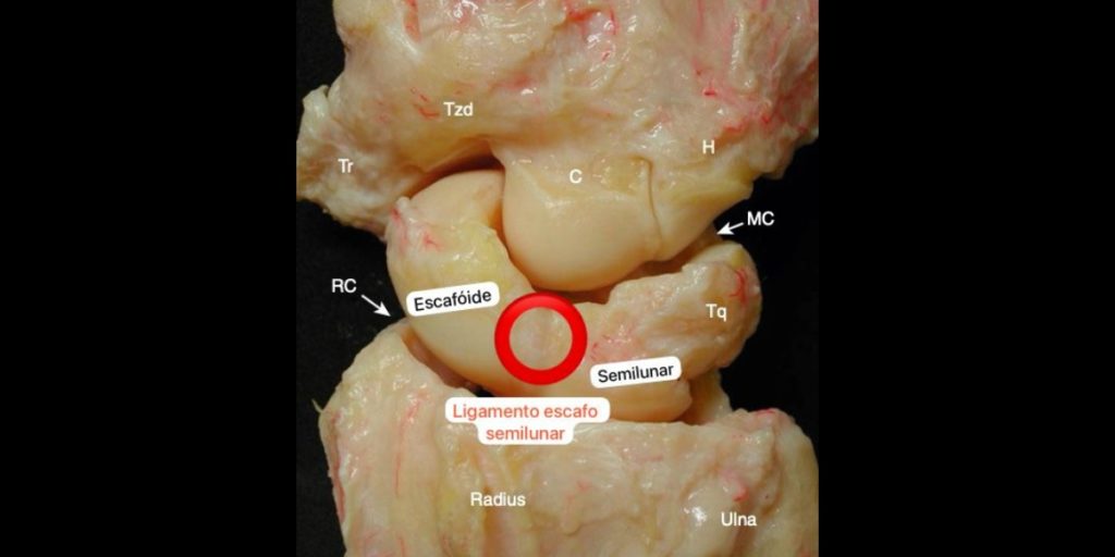 Lesão do ligamento escafossemilunar